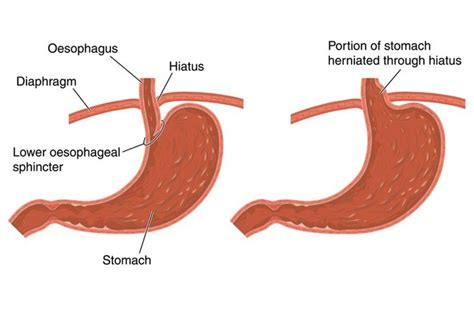 How To Fix A Hiatal Hernia Yourself Mzaertopia