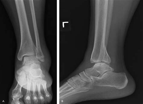 A Surgical Approach To Posterior Pilon Fractures Journal Of