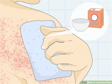 How To Treat Heat Rash 14 Steps With Pictures Wikihow