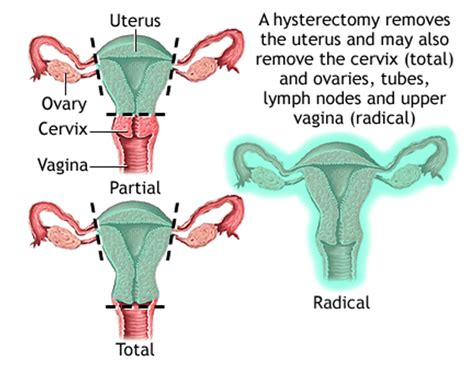 What Is Hysterectomy Rau S Ias