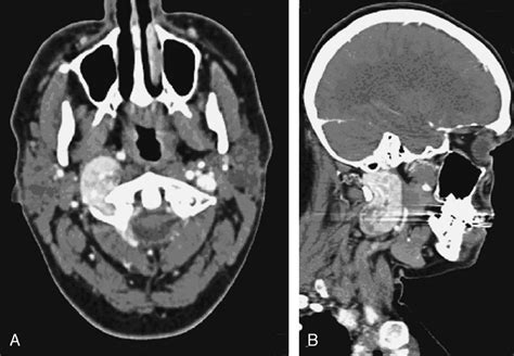 Lipomatous Hemangiopericytoma Of The Skull Base And Paraphar