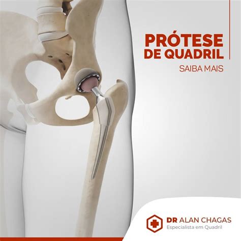 Prótese de Quadril Drº Alan Chagas