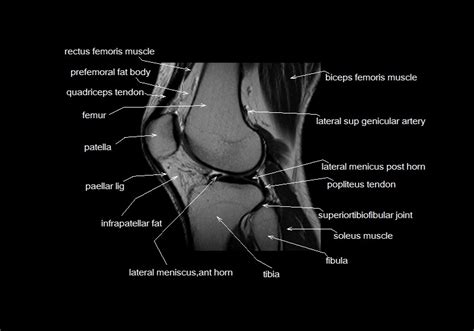Knee Muscle Anatomy Mri Scroll Through The Structures To Understand