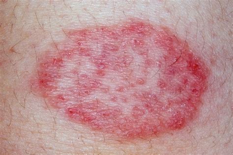 13 common causes of butt rashes and bumps according to mds 50 off