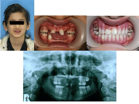 Figure From Dental Management Of Ectodermal Dysplasia Two Clinical Case Reports Semantic