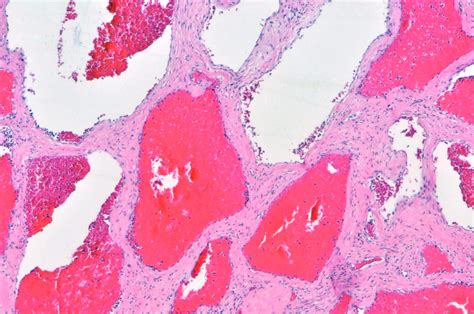 Pathology Cases — Hepatic Hemangioma Billoblog