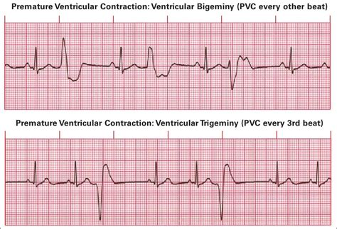 electrocardiogram features of premature ventricular contractions sexiz pix