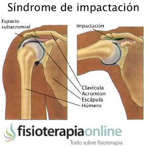 Impingement subacromial o síndrome de impactación Qué es causas