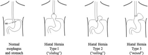 Classification Of Hiatal Hernias Paraesophageal Hernia Open I CLOUD HOT GIRL