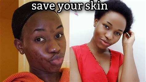 How to clear acne scars in just weeks 