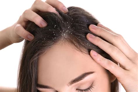Details 60 Best Anti Dandruff Hair Oil Latest Ineteachers
