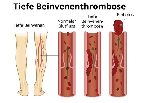 Eine thrombose kann aber auch gänzlich ohne symptome auftreten und sich weiter ausdehnen. Thrombose