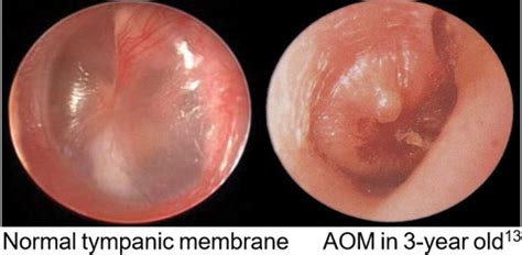 Acute suppurative otitis media (asom) is a complication of aom where there is a perforation of the tympanic membrane with mucopurulent discharge. Acute otitis media - Emergency guideline | Children's ...
