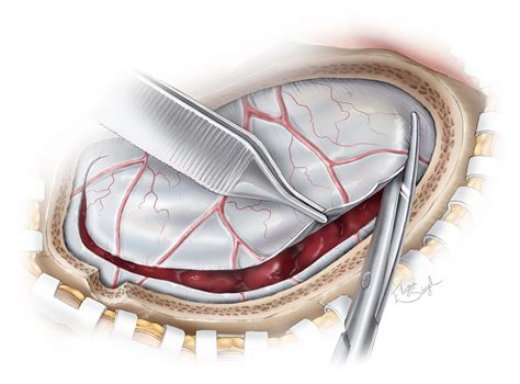 Acute Subdural Hematoma The Neurosurgical Atlas