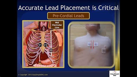 Endocardial Lv Lead Placement Literacy Basics