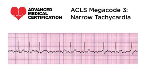 Acls Megacode 3 Narrow Complex Tachycardia