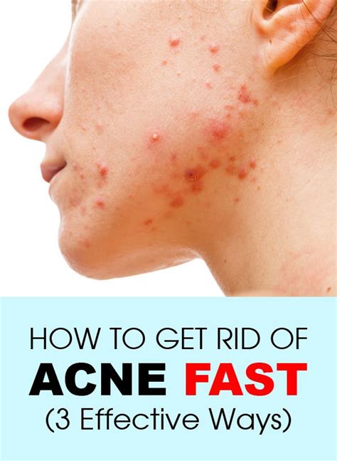 How long do you keep cleansers on your face? How To Get Rid of Acne Fast (3 Effective Ways) | Best of ...