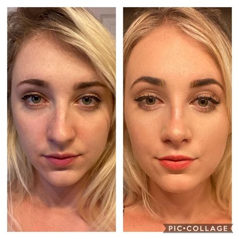 Before And After 12 Days Post Op Rhinoplasty Plasticsurgery