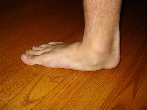 What Is An Accessory Navicular Syndrome Almawi Limited The Holistic