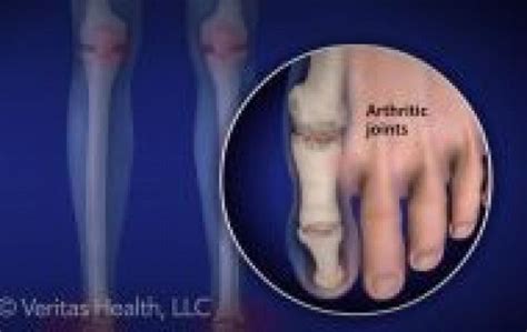 Foot Ankle Ra Jointpainrelief In 2020 Types Of Arthritis Rheumatoid