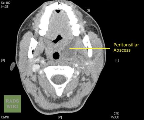 Peritonsillar Abscess Uvula Deviation