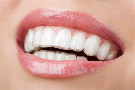 Invisalign Leeds Invisible Braces Clear Brace Dentists £1600