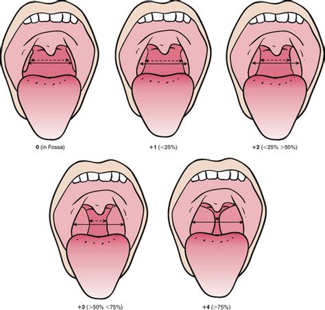Tonsil Rating Scale