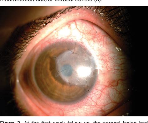 Figure 3 From Management Of Corneal Pannus Caused By Late Stage
