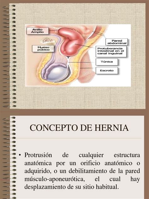 Hernia Inguinal 120912212802 Phpapp01 Pdf Abdomen Medicina Clinica