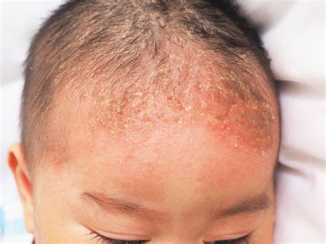 10 Frequently Asked Questions About Cradle Cap Facty Health