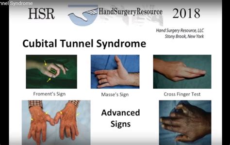 Cubital Tunnel Syndrome —