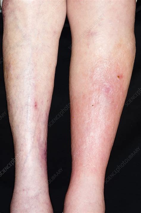 Deep Vein Thrombosis In The Leg Stock Image C Science