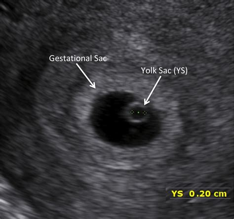 5 Week Ultrasound Yolk Sac Hot Sex Picture - vrogue.co