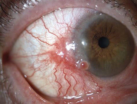 Conjunctival Squamous Cell Carcinoma Nejm