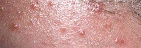 Folliculitis Causes Symptoms And Treatment Skinsight Hot Sex Picture