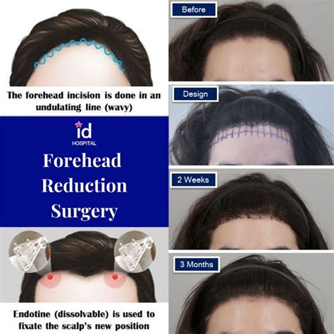 Forehead Reduction Surgery At Id Hospital Forehead Reduction