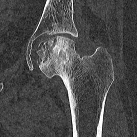 Hip Avascular Necrosis Radiology Case Radiopaedia Org