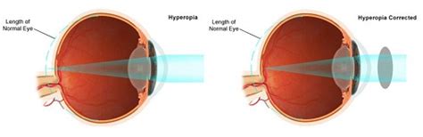Hyperopia What It Is What Causes It And How To Treat It
