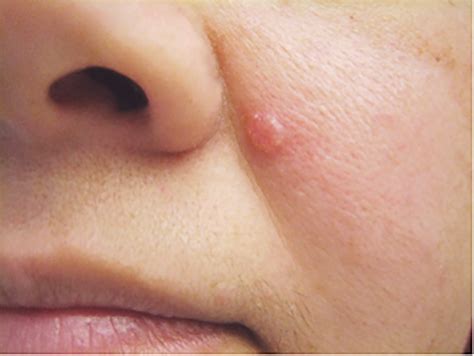 Basal Cell Skin Cancer On Face Cancerwalls