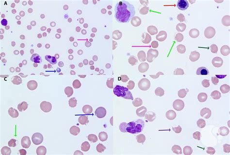 Peripheral Blood Smear Findings In Covid Coagulopathy