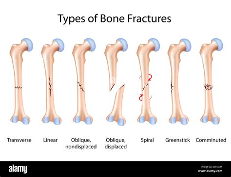 Partial Bone Fracture