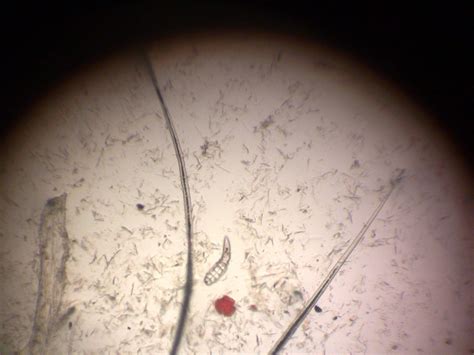 Demodex Mite Through Microscope Demodex Demodex Mites Mites