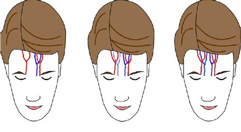A Paramedian Forehead Flap Based On The Axial Artery And Vein