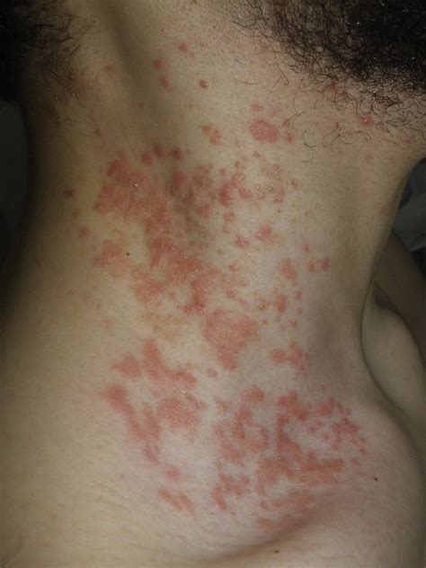 Pp Clinical Presentation Of Patient 2 Erythematous Papules And