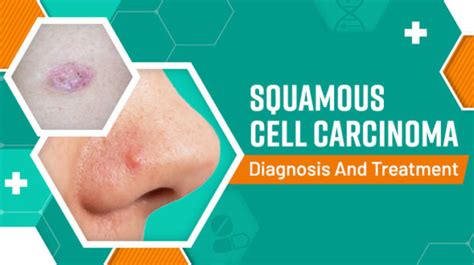 Squamous Cell Carcinoma Diagnosis And Treatment Dermatologist
