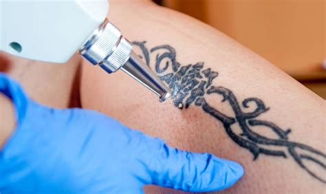 Do You Regret Tattoos Investigate The Tattoo Removal Industry Flyatn