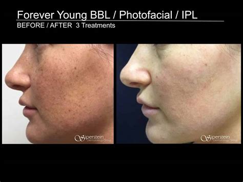 Forever Young Bbl Ipl Photofacial Siperstein Dermatology Group