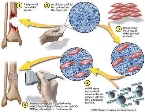 Can Broken Bones Heal Themselves Microbubbles Sound And Gene Therapy