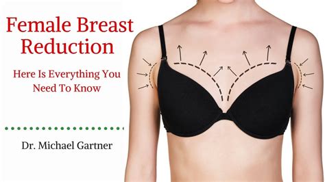 Breast Reduction Surgery Female Dr Gartner Youtube