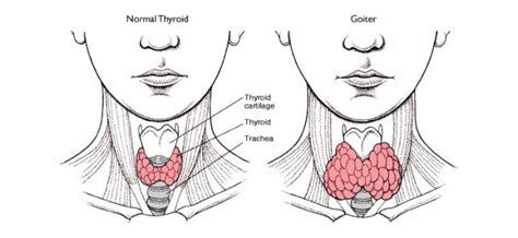 What Is Goiter A Knowledge Archive
